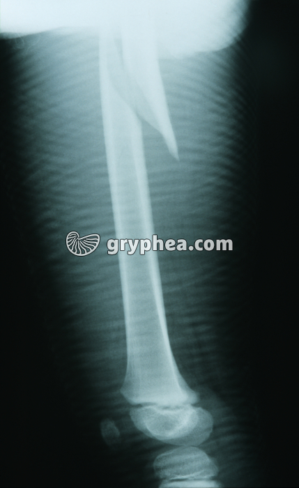 Radiographie de Fémur fracturé - gryphea.com